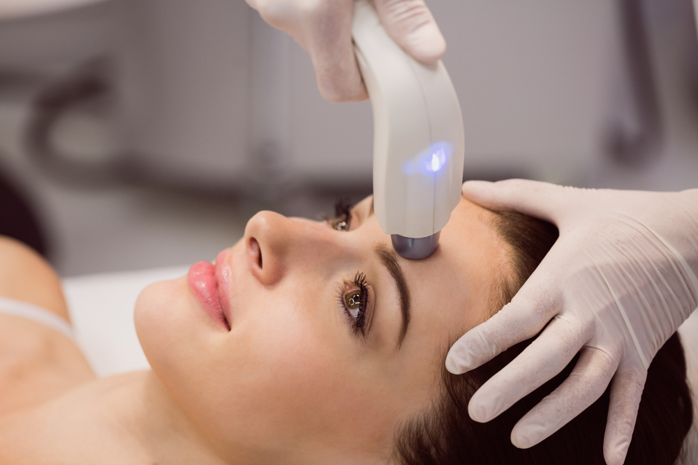 Photo rajeunissement lumière pulsée - Mon Secret Beauté